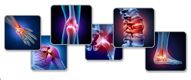 Pain Joints Concept Skeleton Muscle