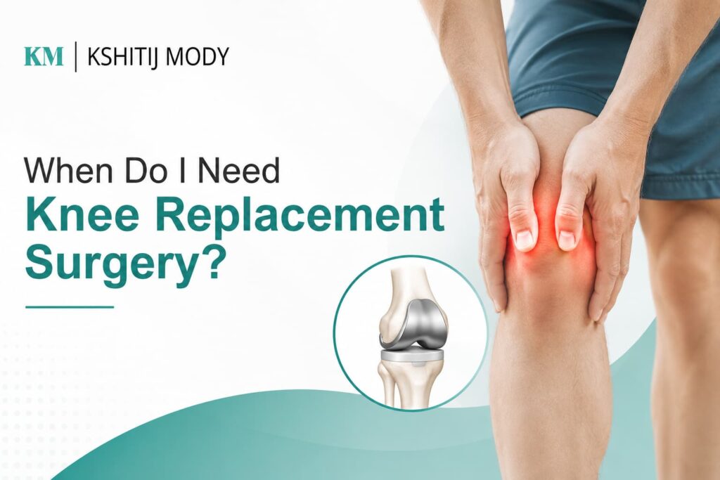 When Do I Need Knee Replacement Surgery